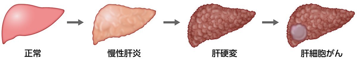 ウイルス肝炎から肝細胞がんへの進行のイメージ