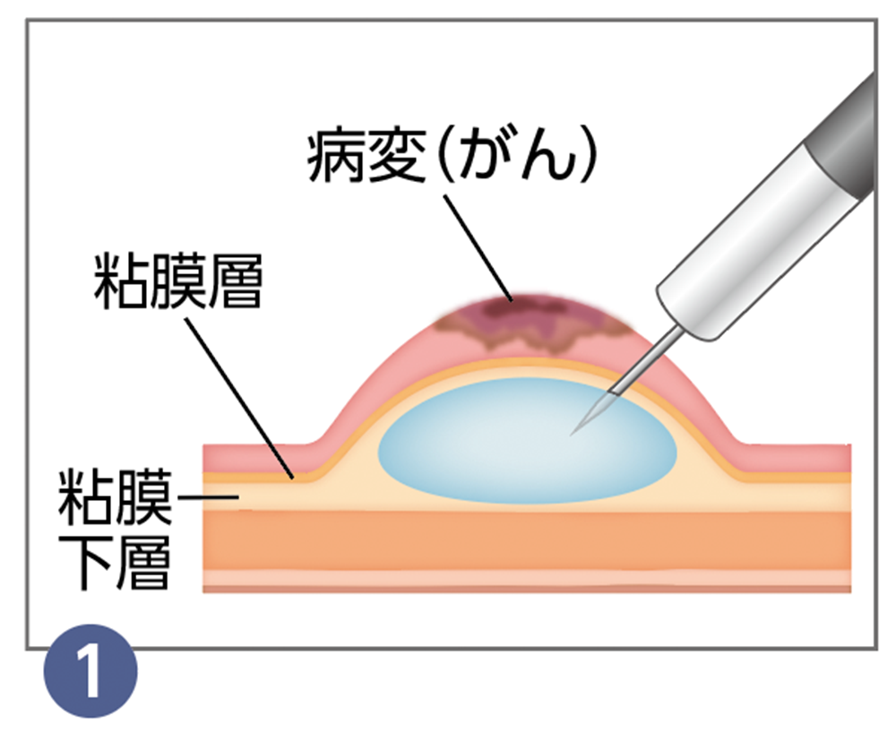 1.内視鏡的粘膜切除術（EMR）