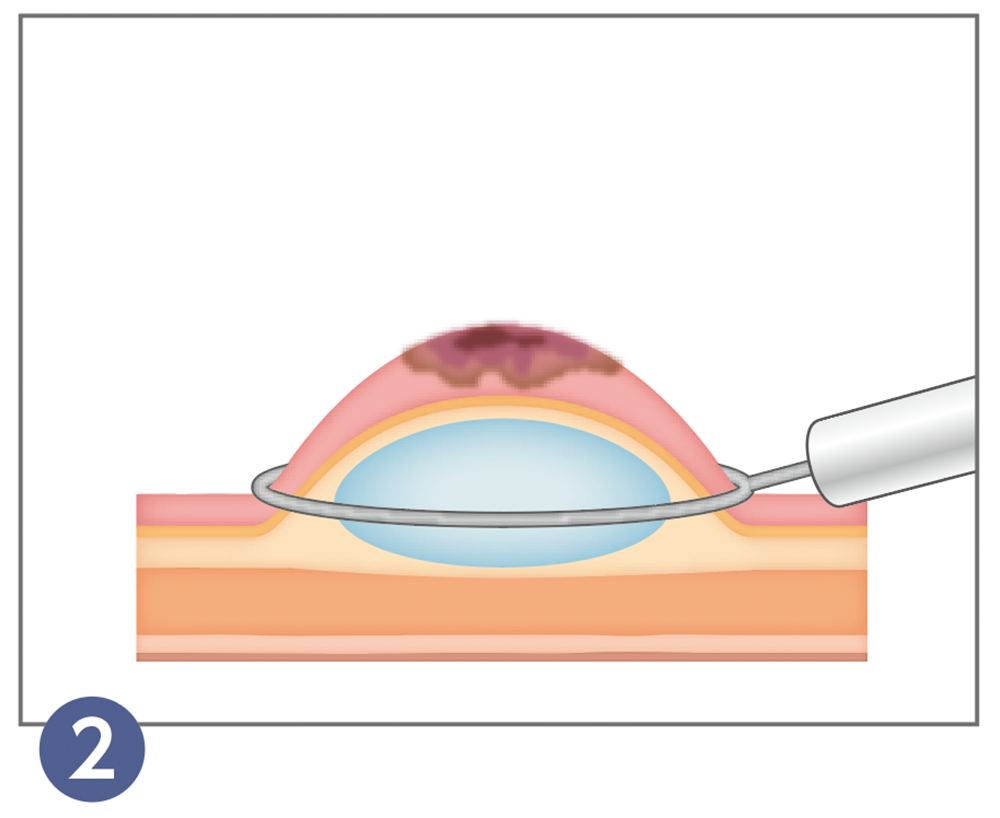 2.内視鏡的粘膜切除術（EMR）