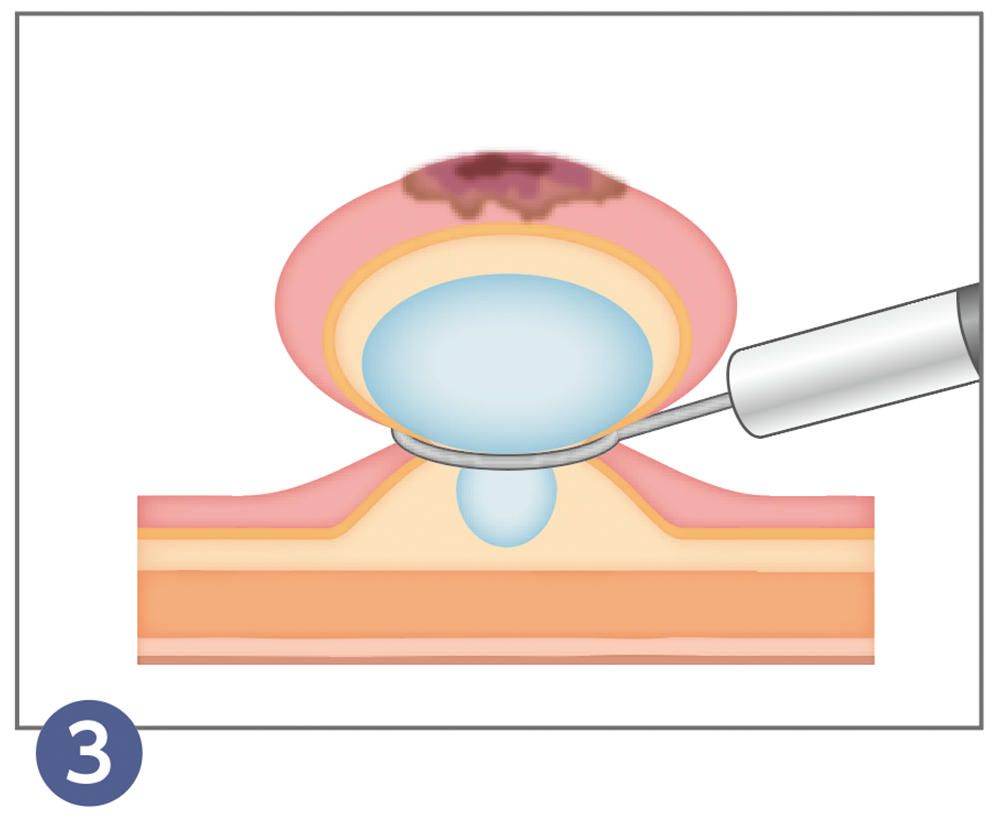 3.内視鏡的粘膜切除術（EMR）