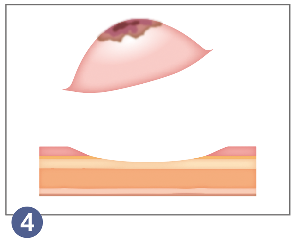 4.内視鏡的粘膜切除術（EMR）
