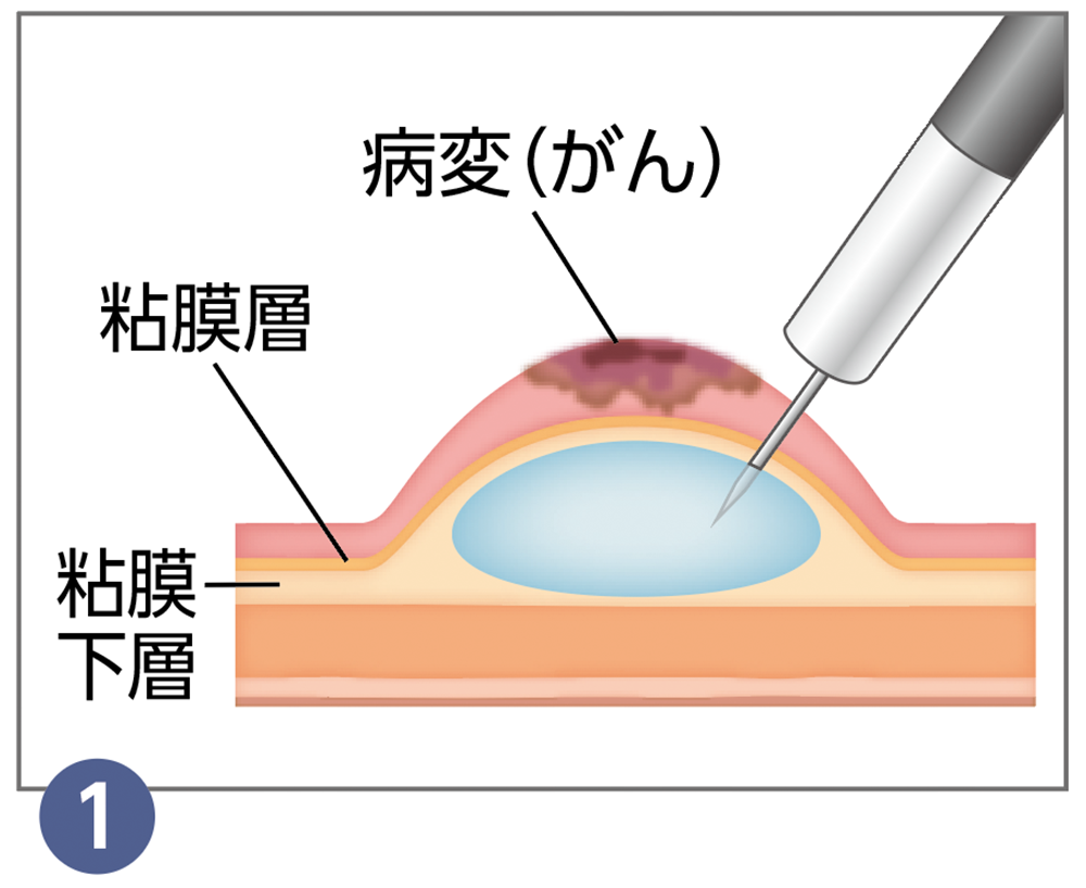 1.内視鏡的粘膜下層剥離術（ESD）