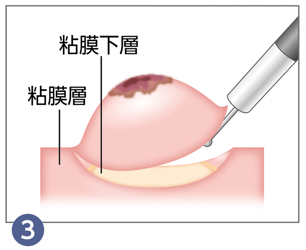 3.内視鏡的粘膜下層剥離術（ESD）