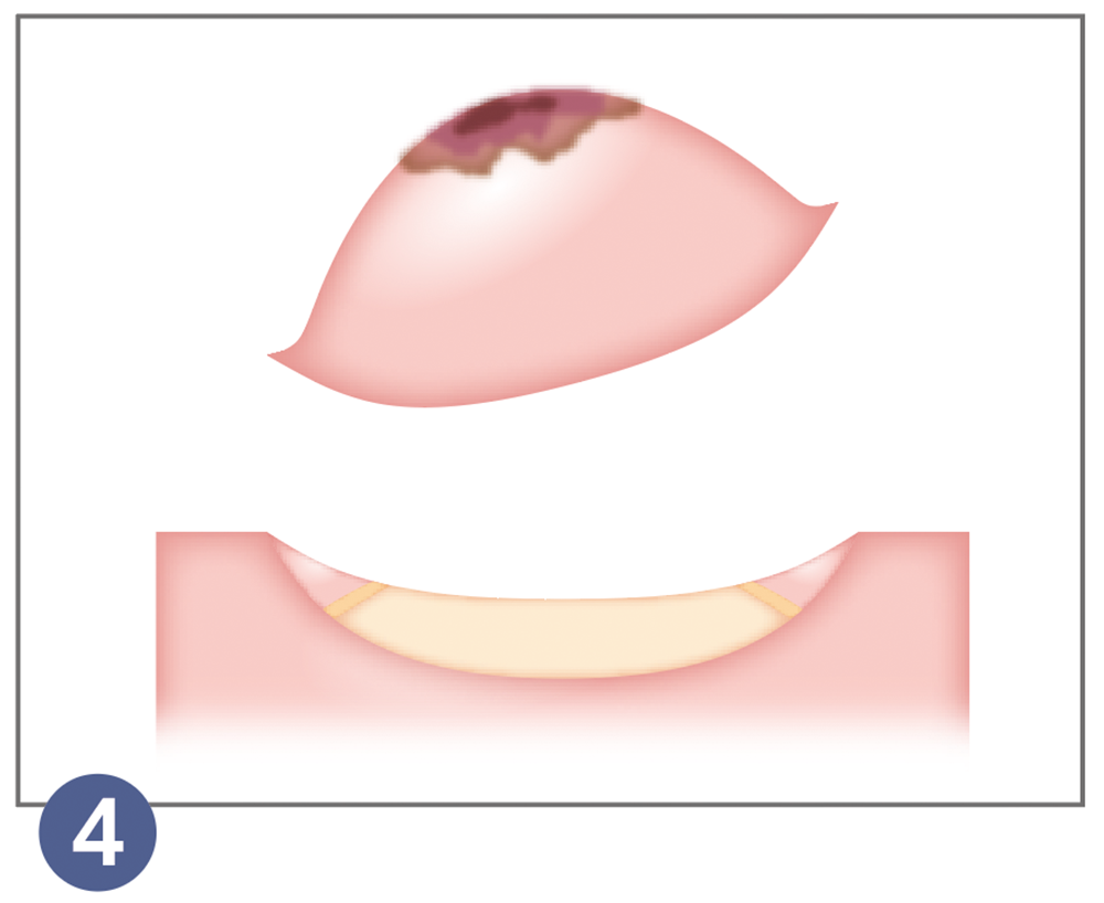 4.内視鏡的粘膜下層剥離術（ESD）