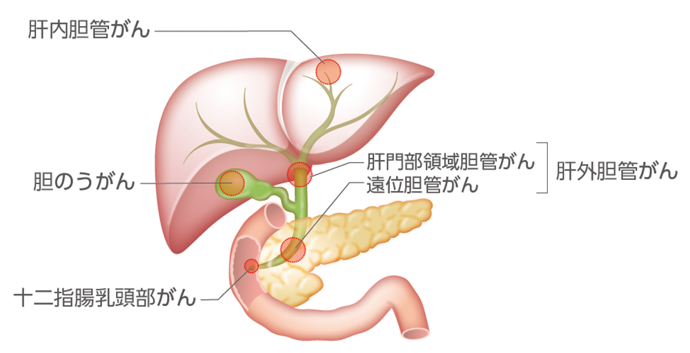 胆道がんの分類のイメージ​