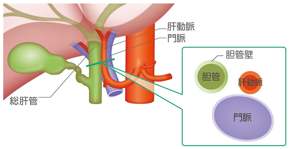 遠位胆管がんの部位のイメージ​