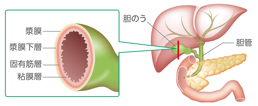 胆のうがんの部位のイメージ