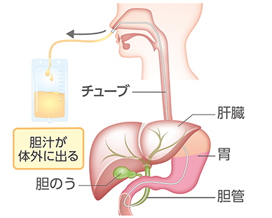 胃を通って鼻から
体の外へ胆汁を出す場合の体内の様子のイラスト