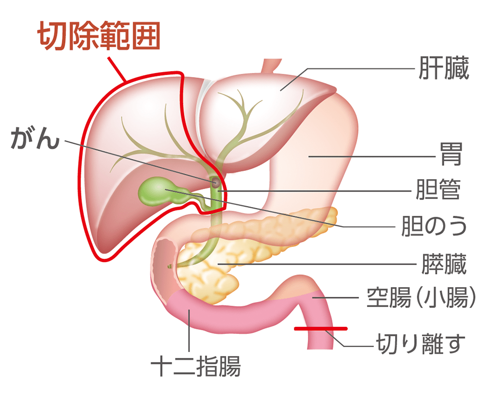 肝門部領域胆管がんの手術例のイラスト（切除前）