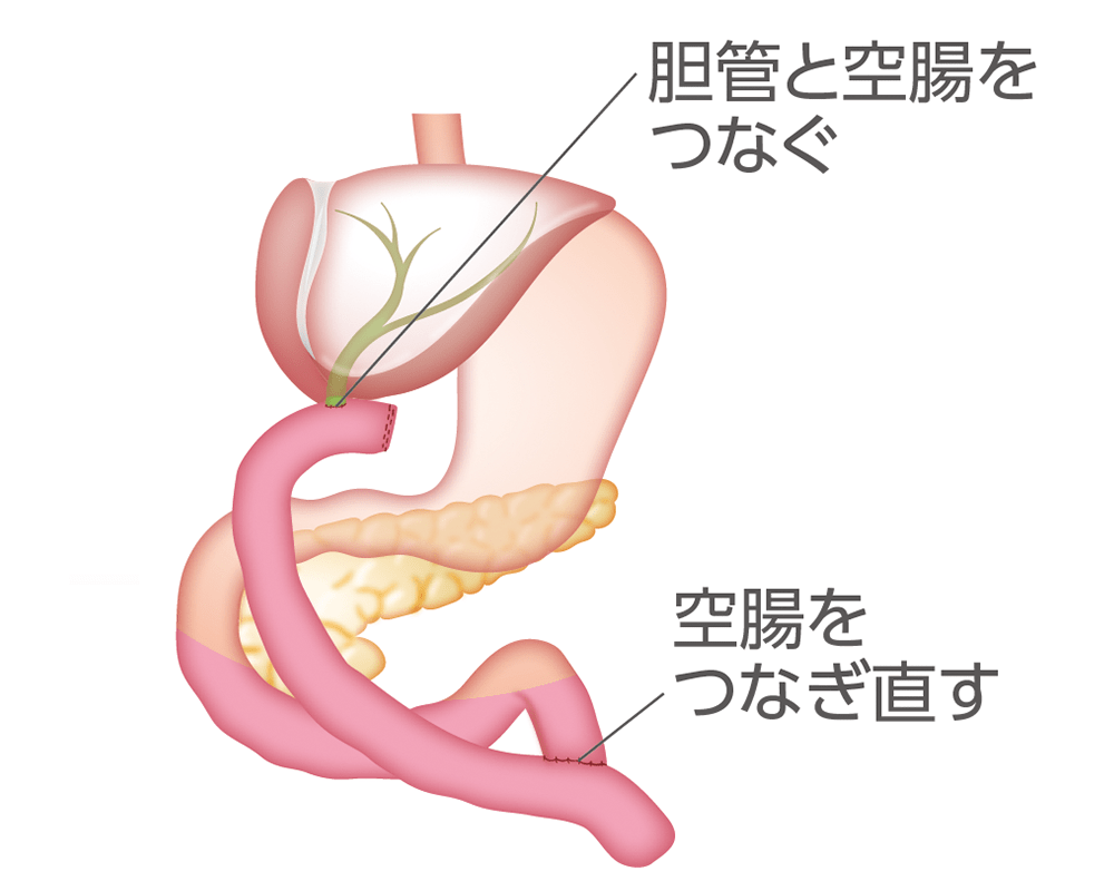 肝門部領域胆管がんの手術例のイラスト（再建後）