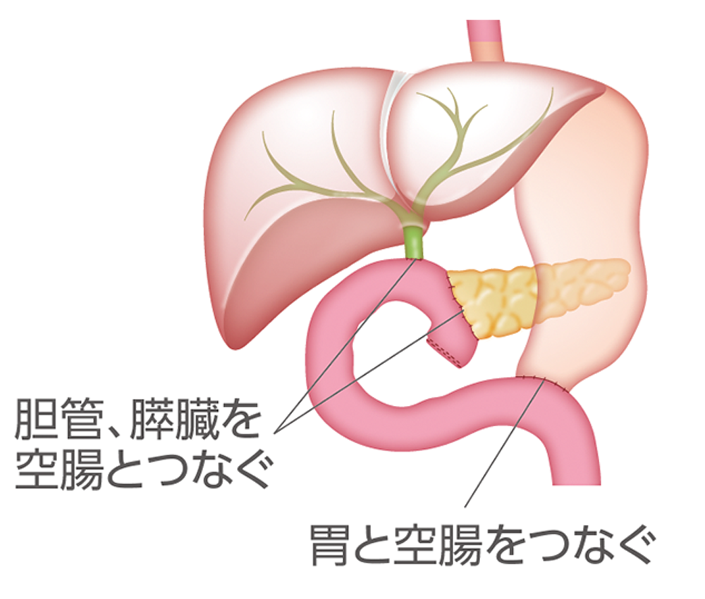 遠位胆管がん、十二指腸乳頭部がんの手術例のイラスト（再建後）