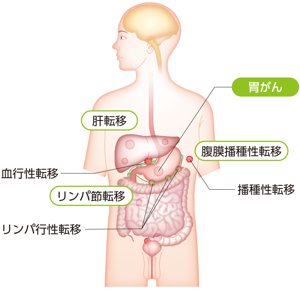 胃がんの主な転移部位