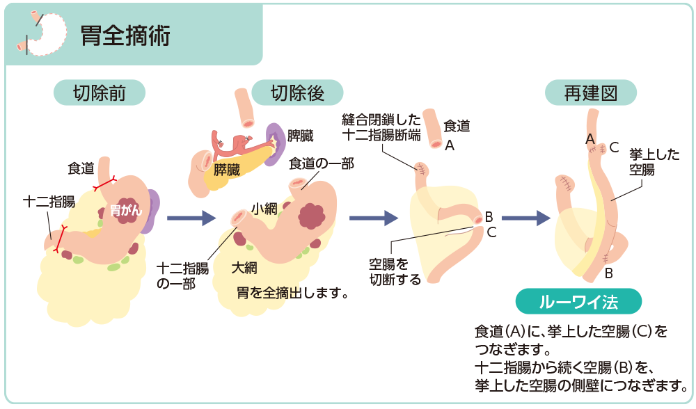 切除術式と消化管再建術（胃全摘術）