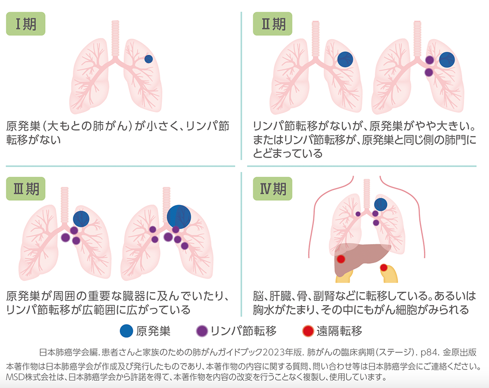 肺がんの病期分類（I期、II期、III期、IV期）