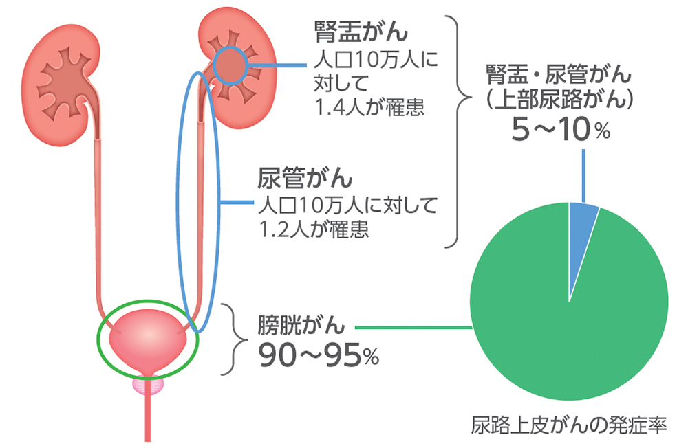 尿路上皮がんの部位別発症率