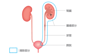 腎尿管全摘除術と膀胱部分切除術