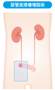 尿管皮膚瘻増設術